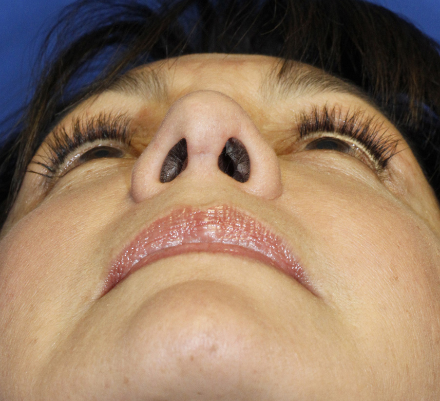 After rhinoplasty base photo