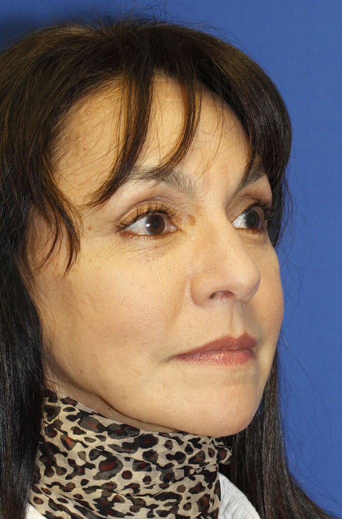 After rhinoplasty oblique photo