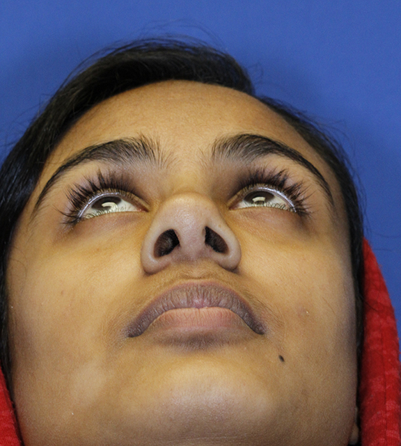 After rhinoplasty base