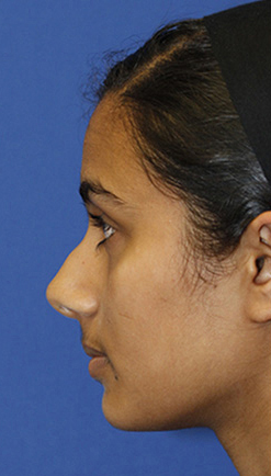 Before Rhinoplasty left profile