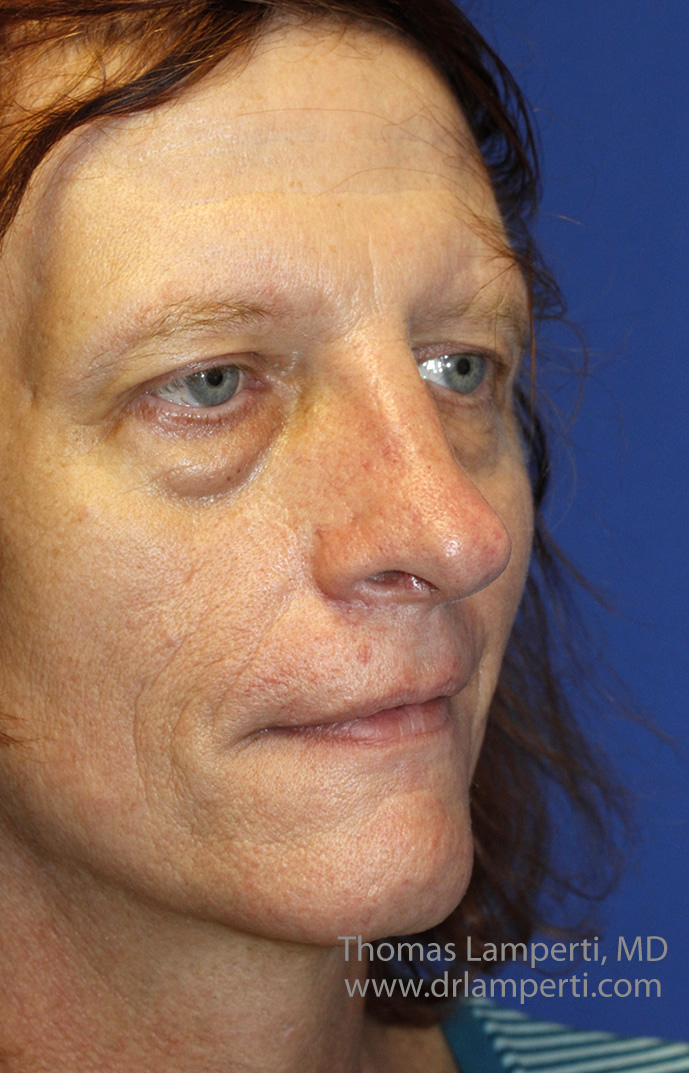 After Feminization Rhinoplasty Oblique