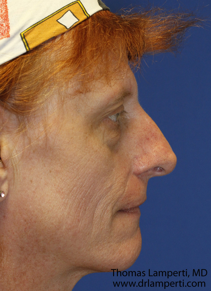 Before Feminization Rhinoplasty Profile