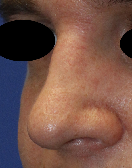 After Rhinoplasty Oblique