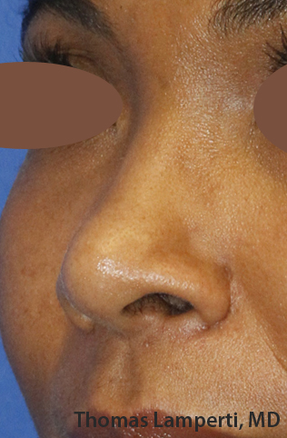 After Ethnic Rhinoplasty Oblique