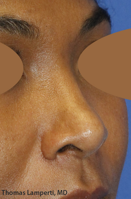 After Ethnic Rhinoplasty Oblique