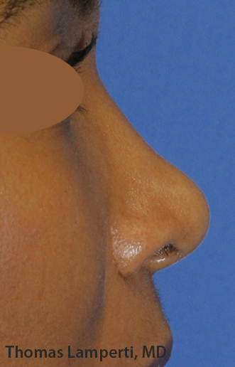 After Ethnic Rhinoplasty Profile