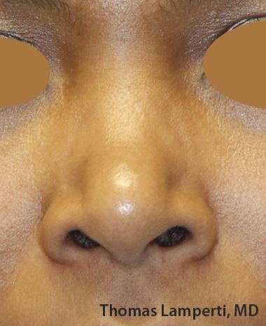 Before Ethnic Rhinoplasty Frontal