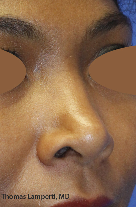 Before Ethnic Rhinoplasty Oblique