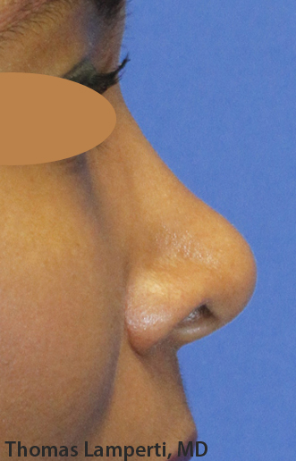 Before Ethnic Rhinoplasty Profile