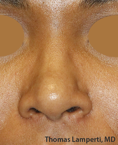 After Ethnic Rhinoplasty Frontal