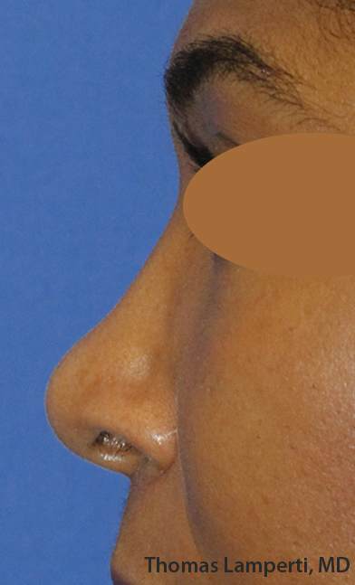 After Ethnic Rhinoplasty Profile