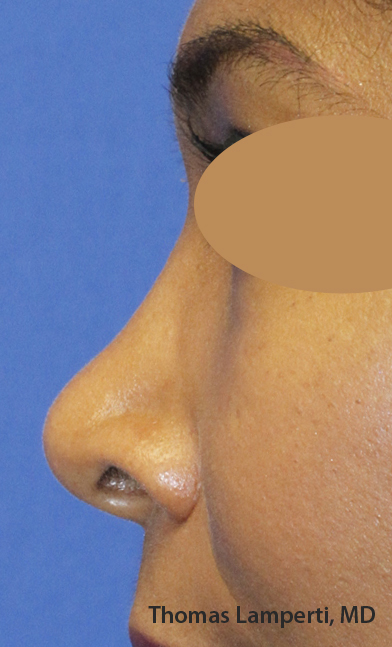 Before Ethnic Rhinoplasty Profile