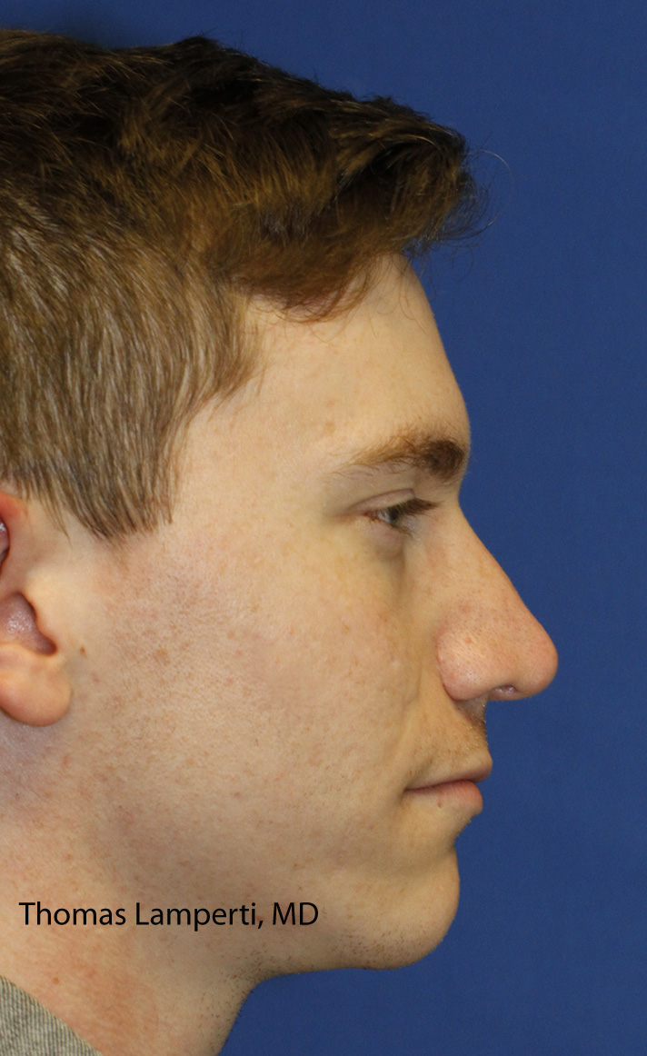 Rhinoplasty After ight Profile