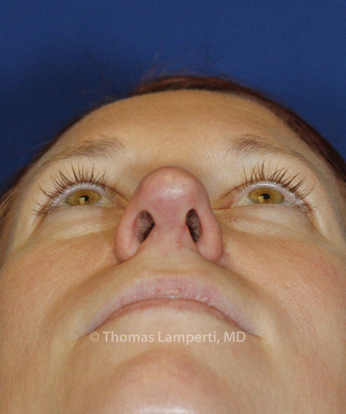 Rhinoplasty After Base