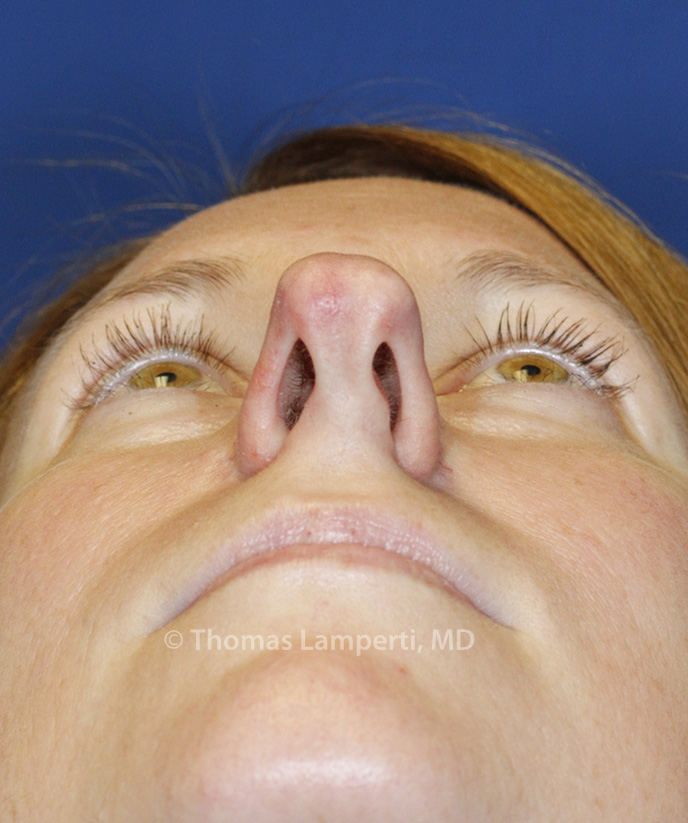 Rhinoplasty Before Base