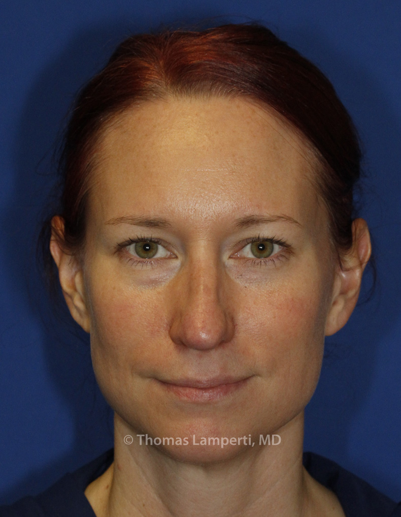 Rhinoplasty After Frontal