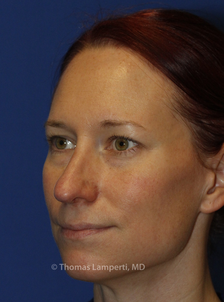 Rhinoplasty After L Oblique