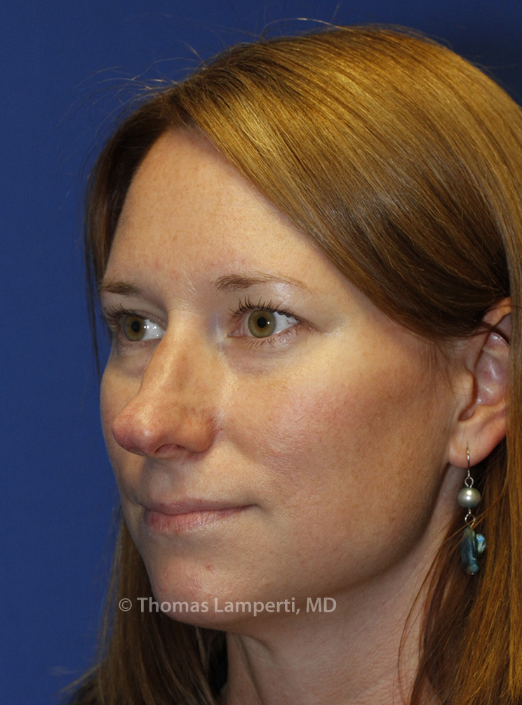 Rhinoplasty Before L Oblique