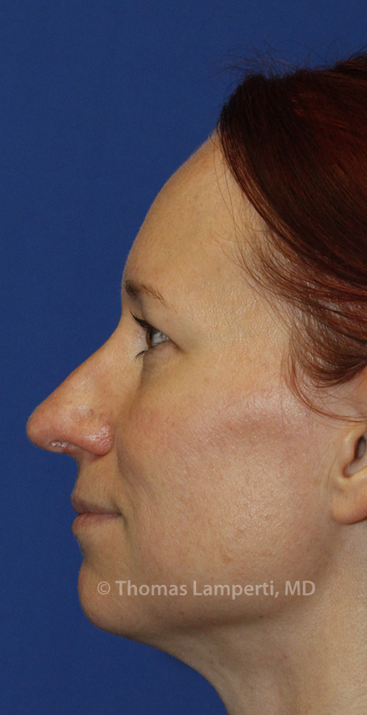 Rhinoplasty After L Profile