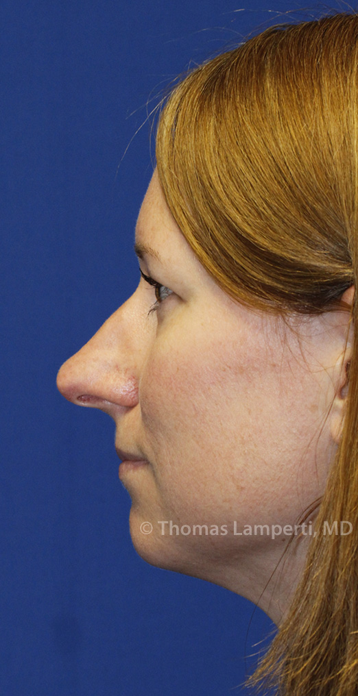 Rhinoplasty Before L Profile