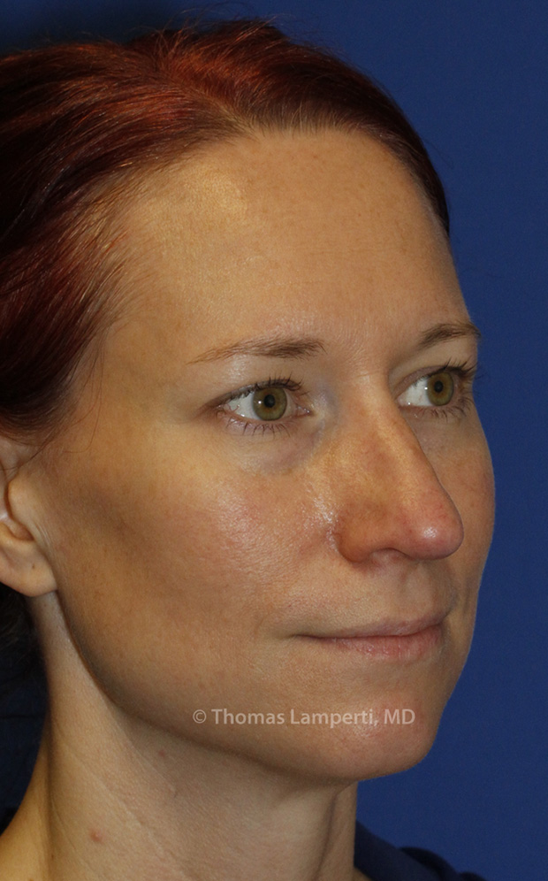 Rhinoplasty After R Oblique