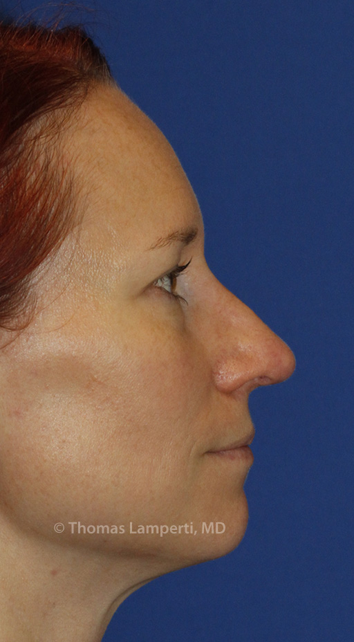 Rhinoplasty After R Profile