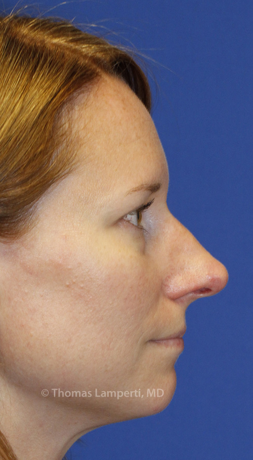 Rhinoplasty Before R Profile