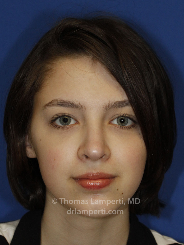 Rhinoplasty After Frontal