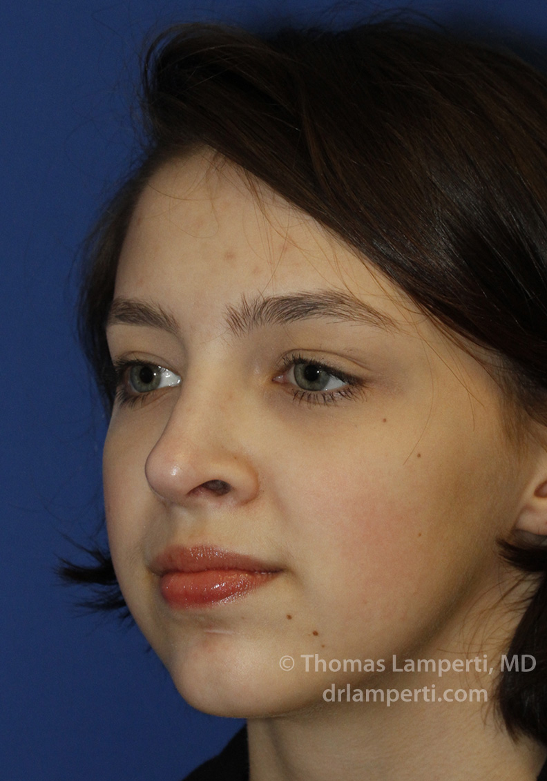 Rhinoplasty After L Oblique