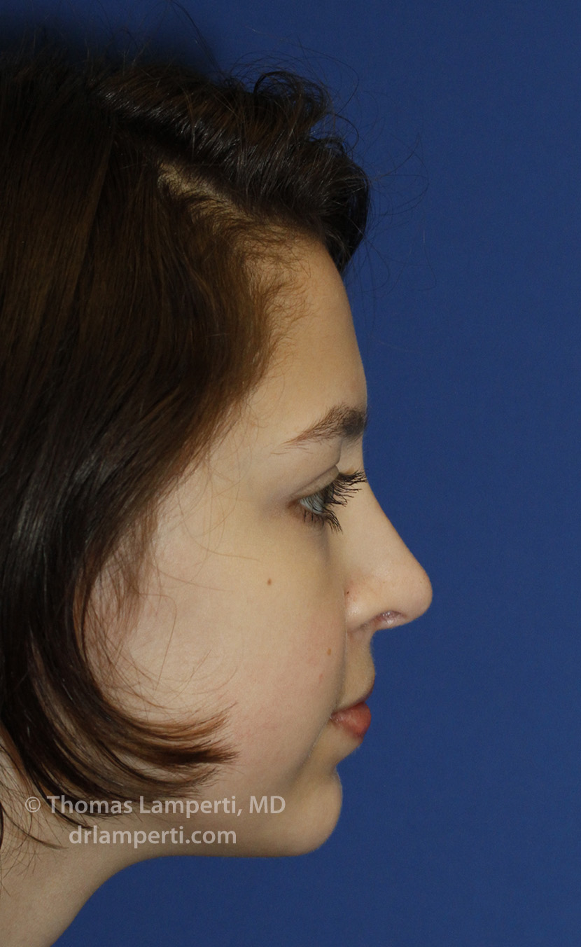 Rhinoplasty After R Profile