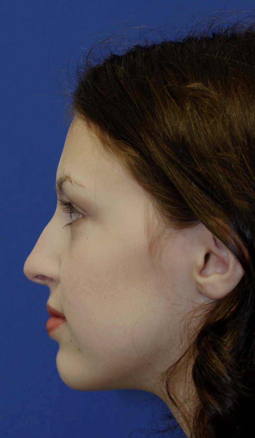 Rhinoplasty Before L Profile