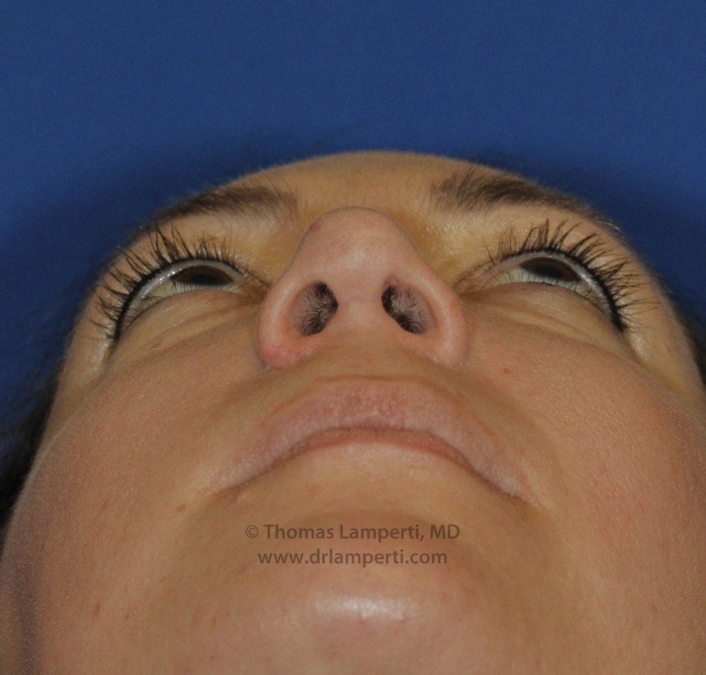 Rhinoplasty After Base