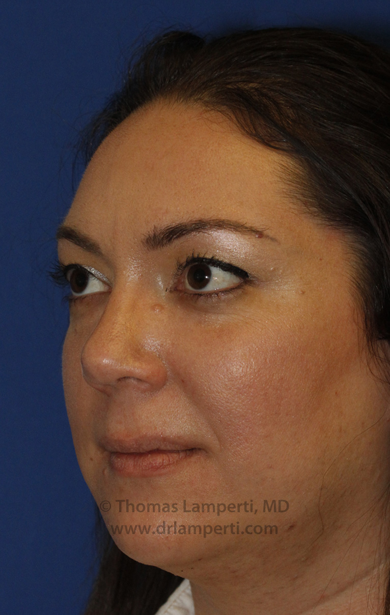 Rhinoplasty After L Oblique