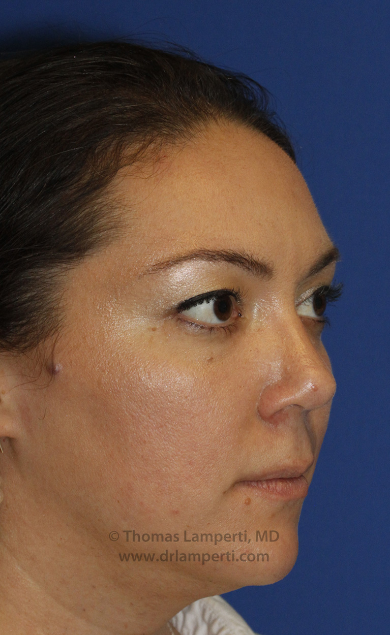 Rhinoplasty After R Oblique