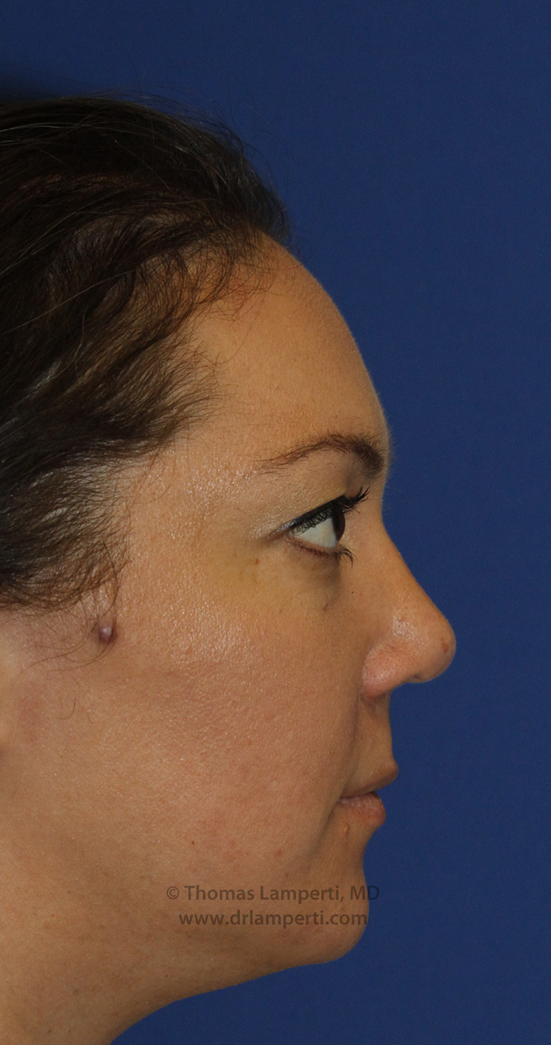 Rhinoplasty After R Profile