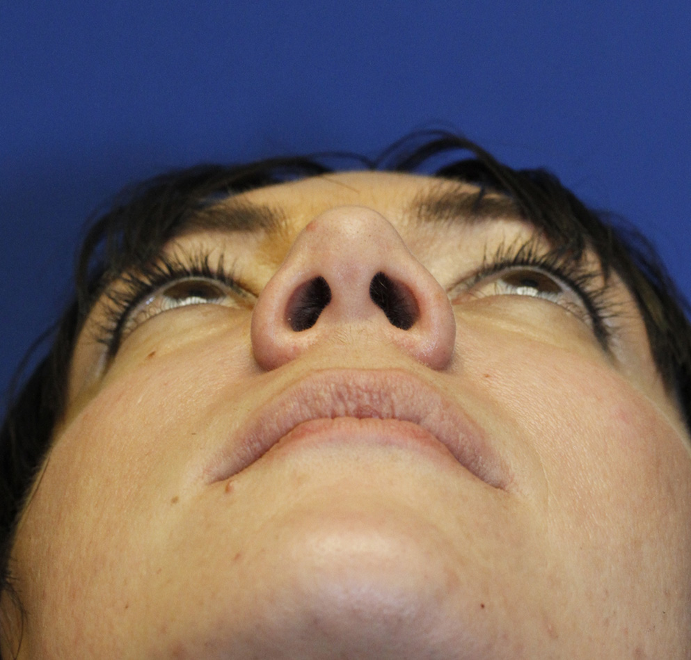 Rhinoplasty Before Base