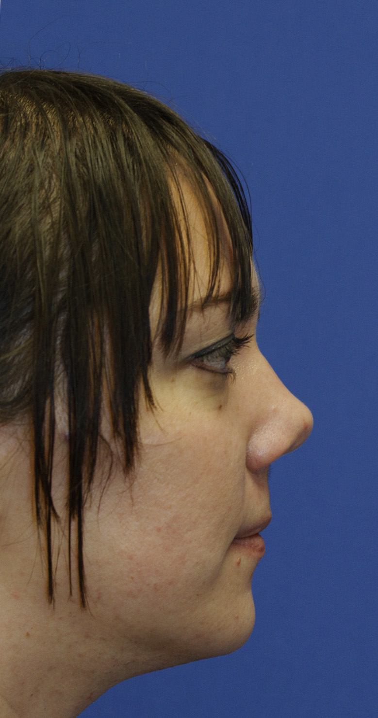 Rhinoplasty Before R Profile