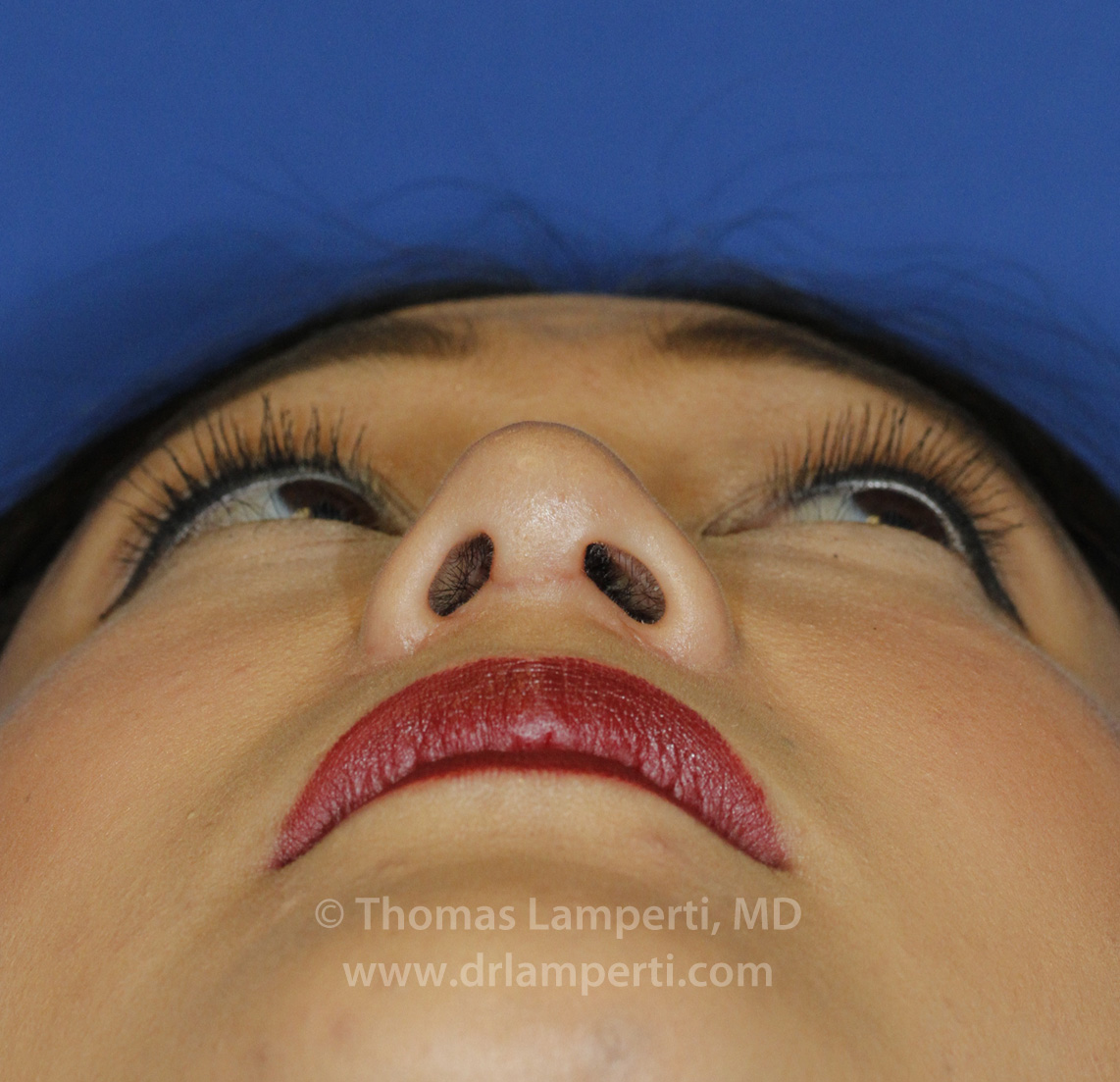 Rhinoplasty After Base