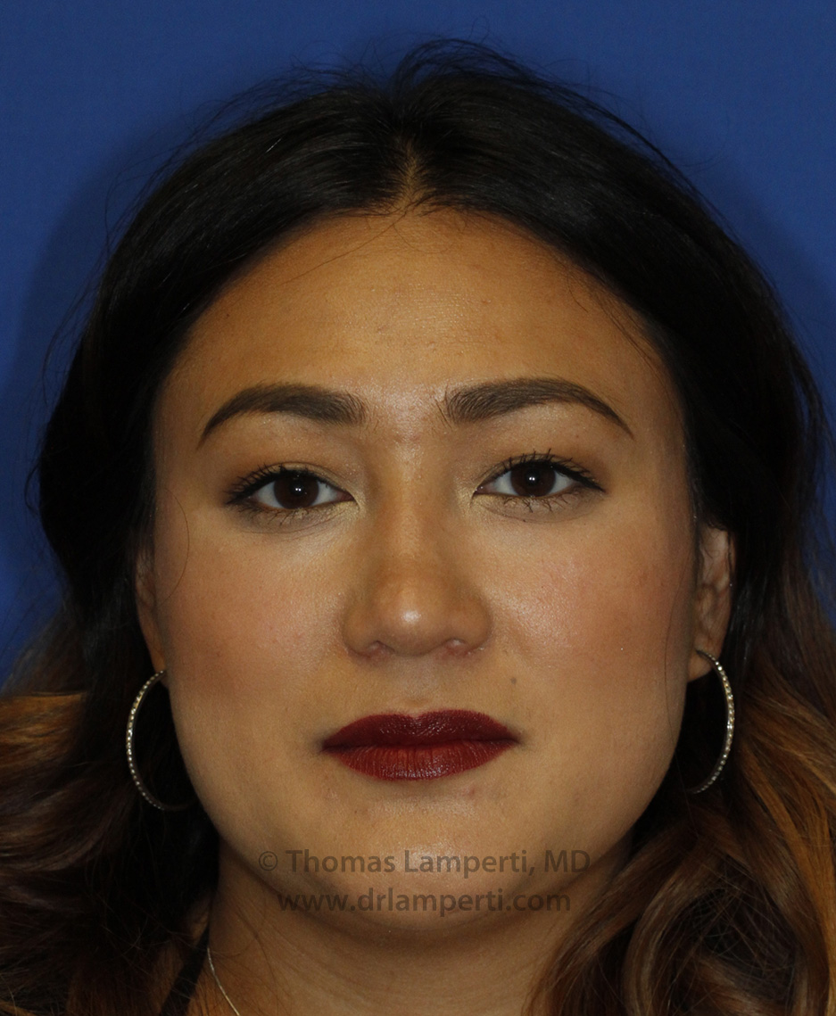 Rhinoplasty After Frontal