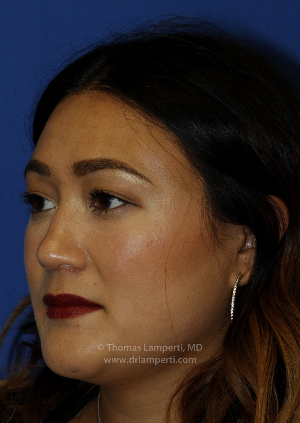 Rhinoplasty After L Oblique