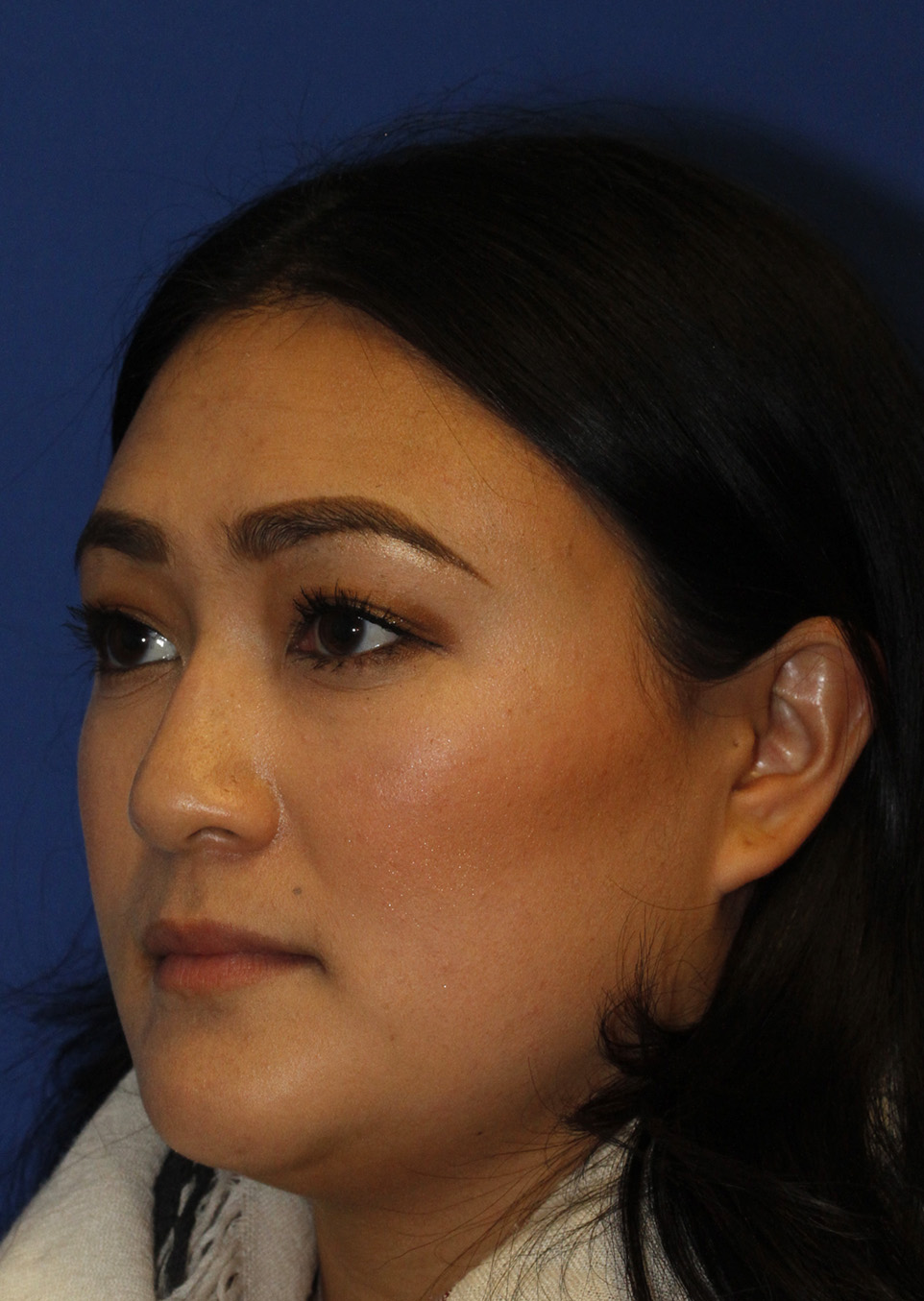 Rhinoplasty Before L Oblique