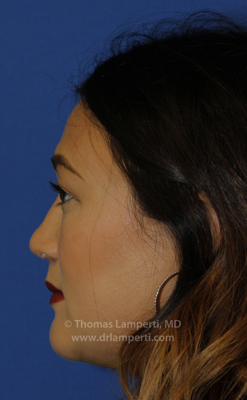 Rhinoplasty After L Profile