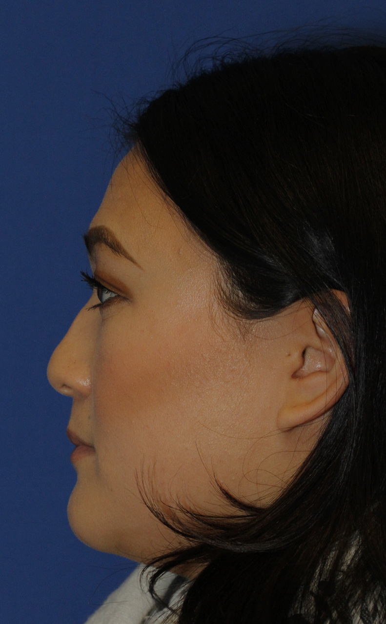 Rhinoplasty Before L Profile