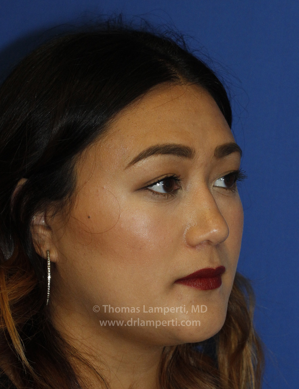 Rhinoplasty After R Oblique