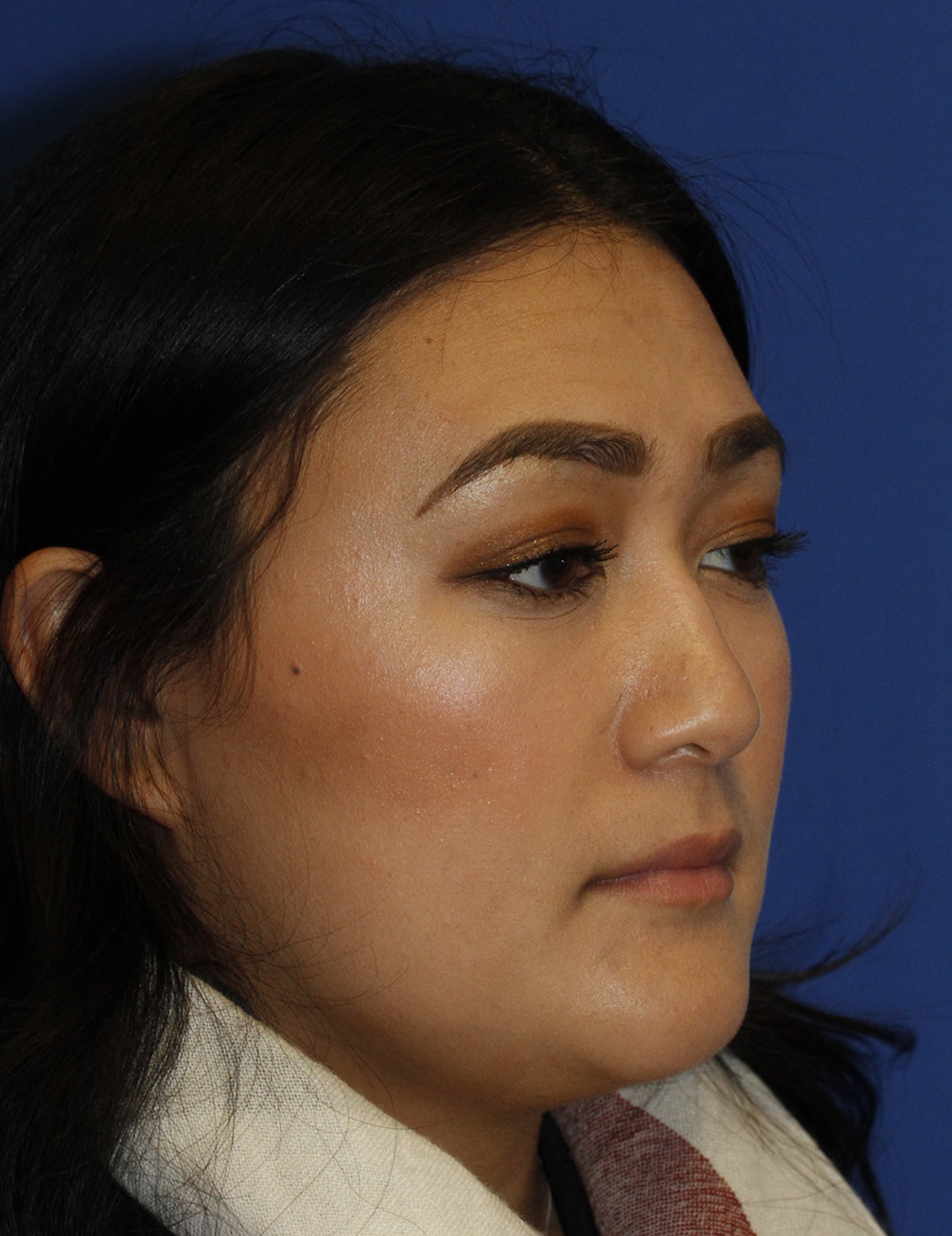 Rhinoplasty Before R Oblique