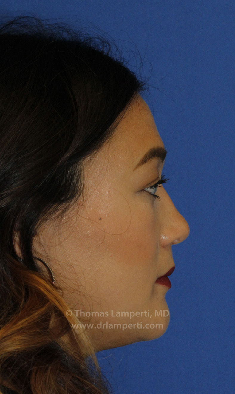 Rhinoplasty After R Profile