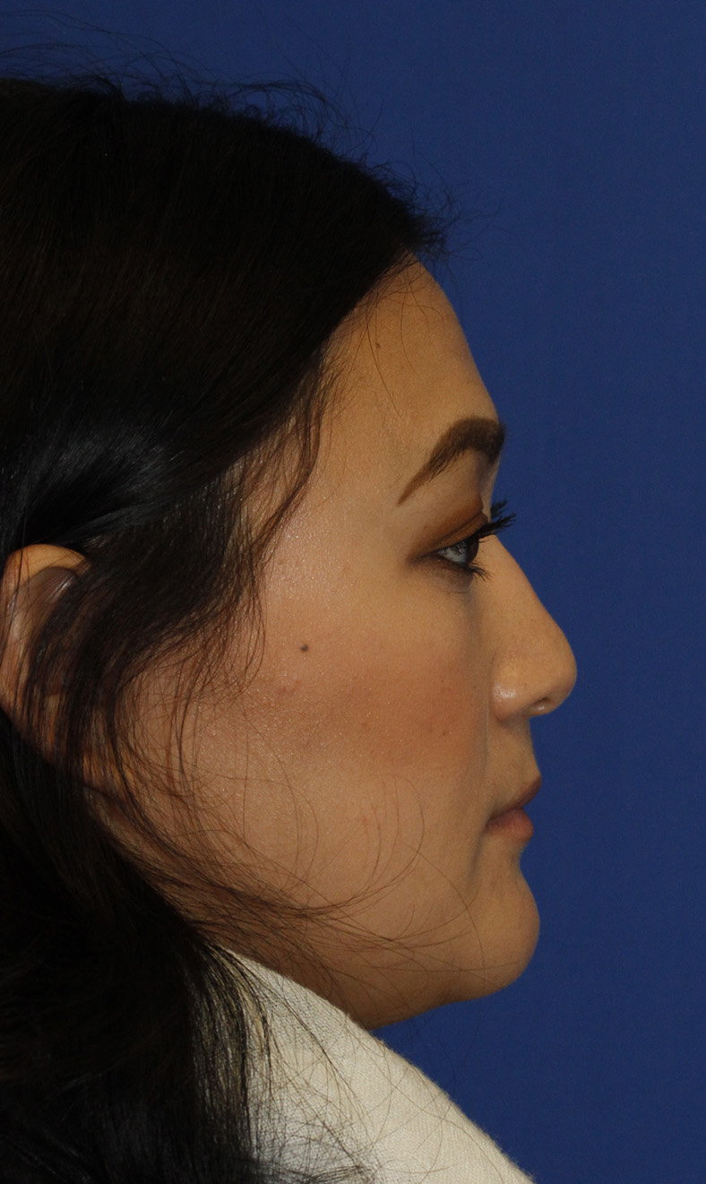 Rhinoplasty Before R Profile