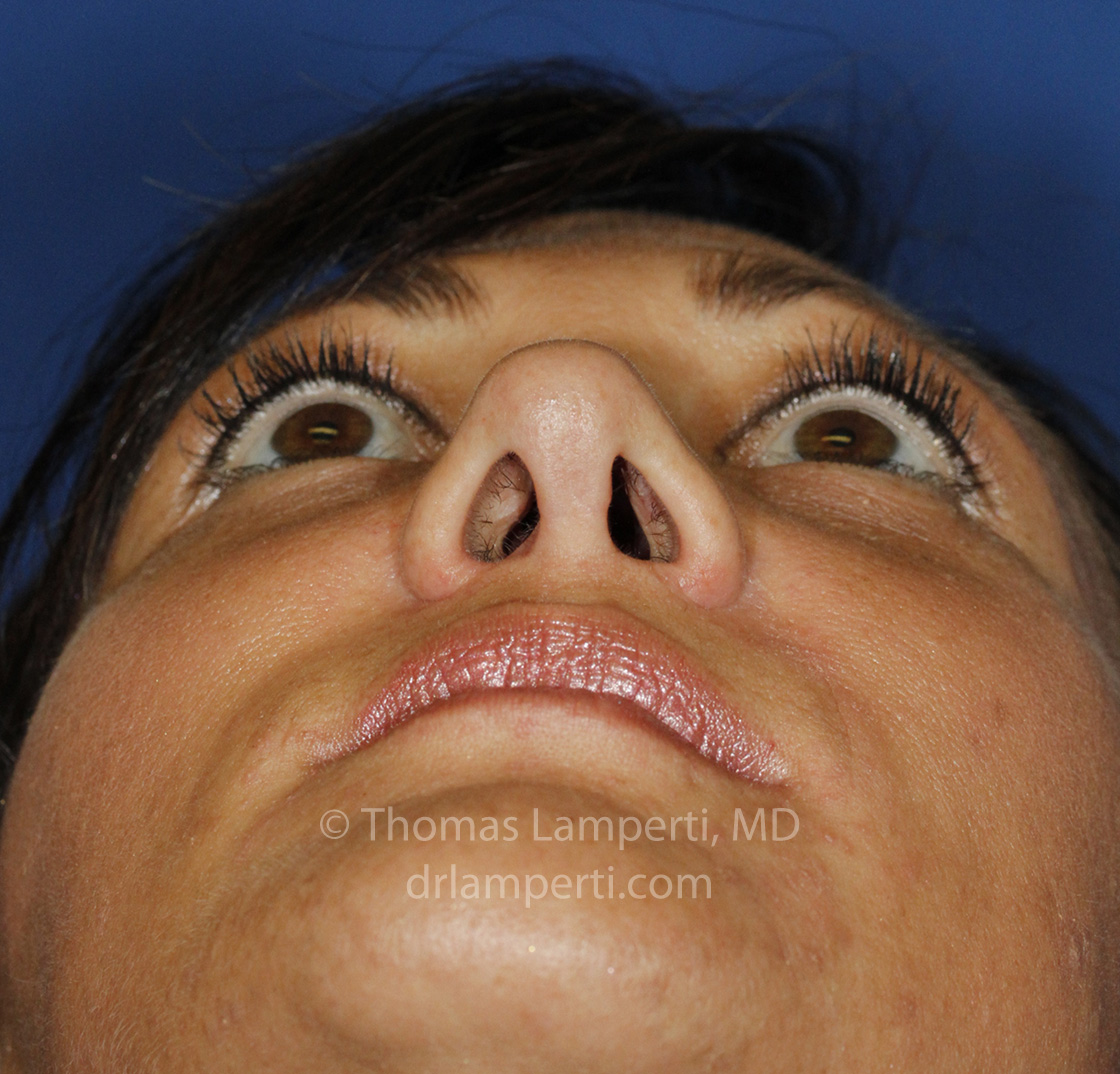 Rhinoplasty After Base