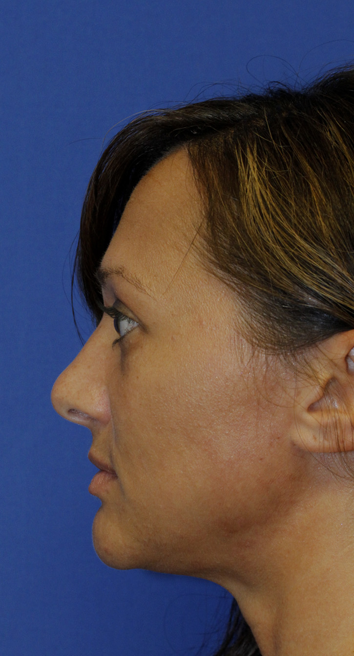 Rhinoplasty Before L Profile