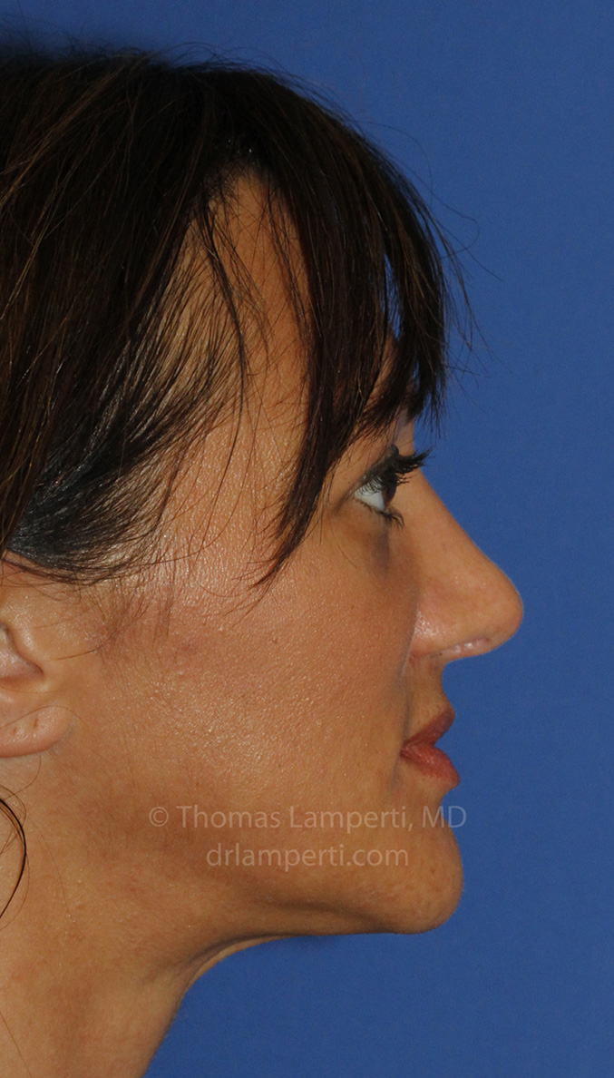 Rhinoplasty After R Profile